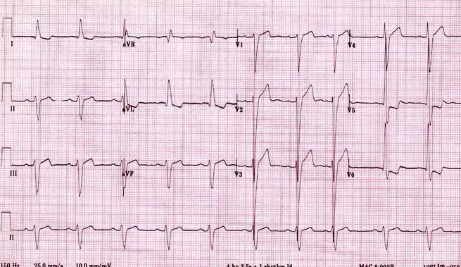 Tăng đáng kể điện áp LV: R đạo trình trước tim rất lớn và sóng S trùng với các đạo trình liền kề