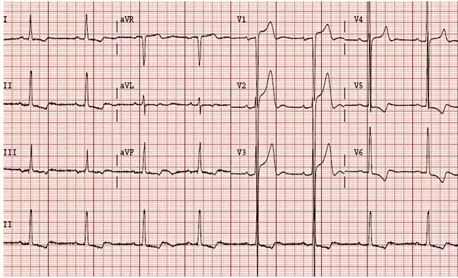 Điện áp QRS rất cao - sóng S trong V3 rất sâu