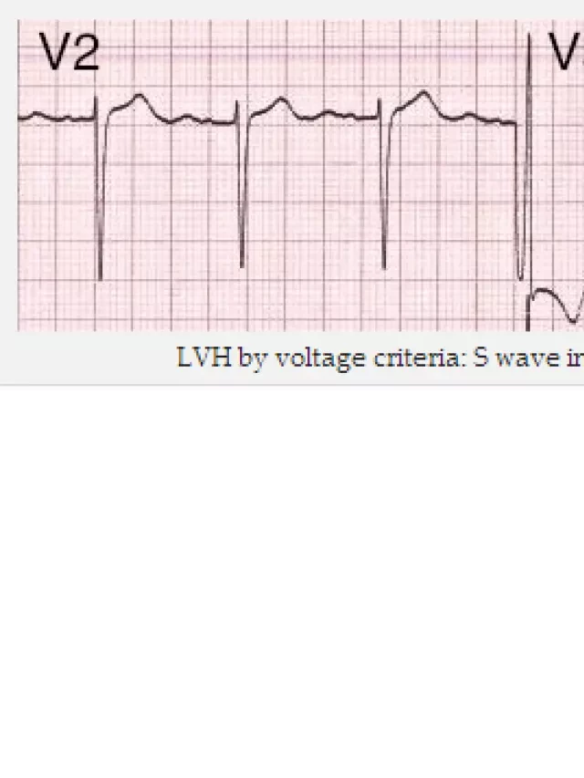   Điện tâm đồ chẩn đoán phì đại tâm thất trái (LVH): Tìm hiểu, chẩn đoán và nhận biết